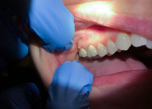 Best Emergency Dental Care for Broken or Chipped Teeth in East Uniontown, PA