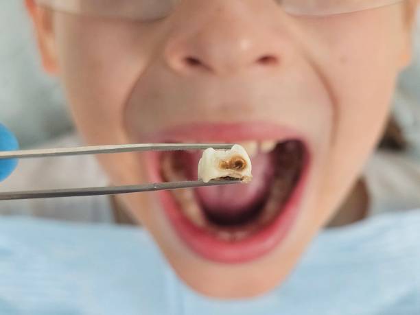 Best Emergency Treatment for Dental Infections or Abscesses in East Uniontown, PA