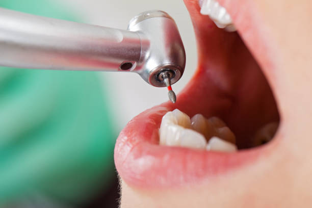 Best Emergency Root Canal Treatment in East Uniontown, PA